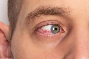 Uveitis in eye Image credit: ©Janeberry - adobe.stock.com
