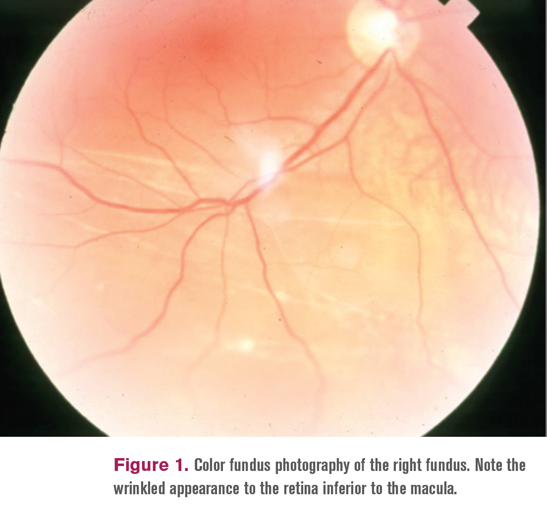 tractional retinal detachment