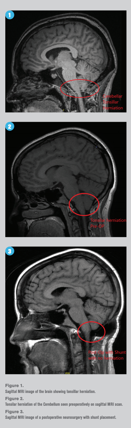 Ocular Symptoms Related To Chiari Disease Ocular Symptoms Related To Chiari Disease