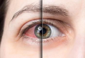 Closeup of dry eye and healthy eye Image credit: AdobeStock/AlessandroGrandini