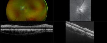 optos MonacoPro captures retinal images in a patient with myopia - Image credit: Optos