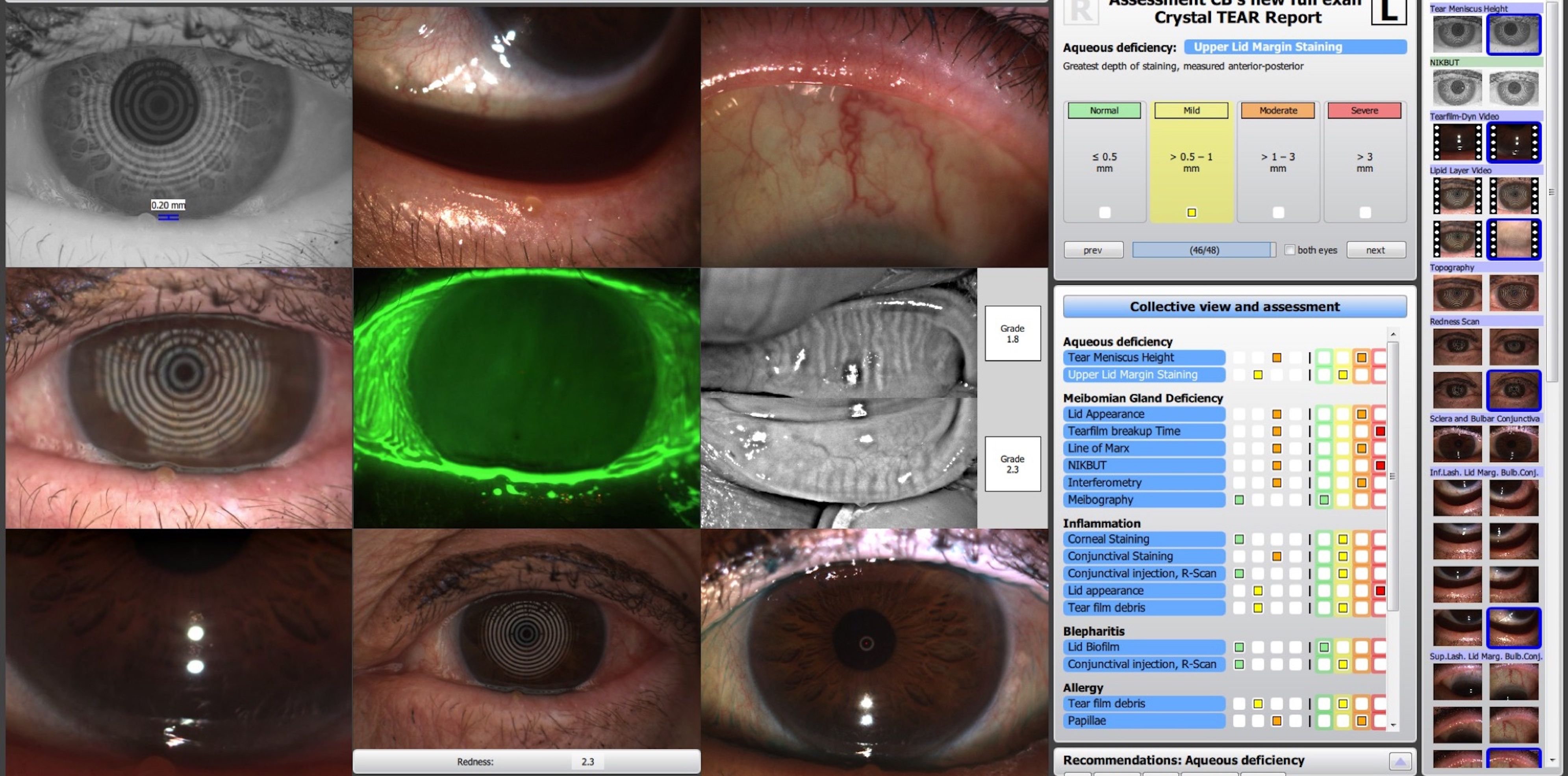 Collage images of Oculus K5M screening performed during routine exam.