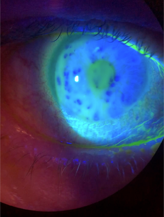 Dry Eye Patient (B)
