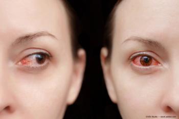 Inflamed eyes