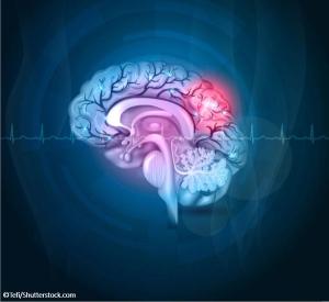 brain image of stroke