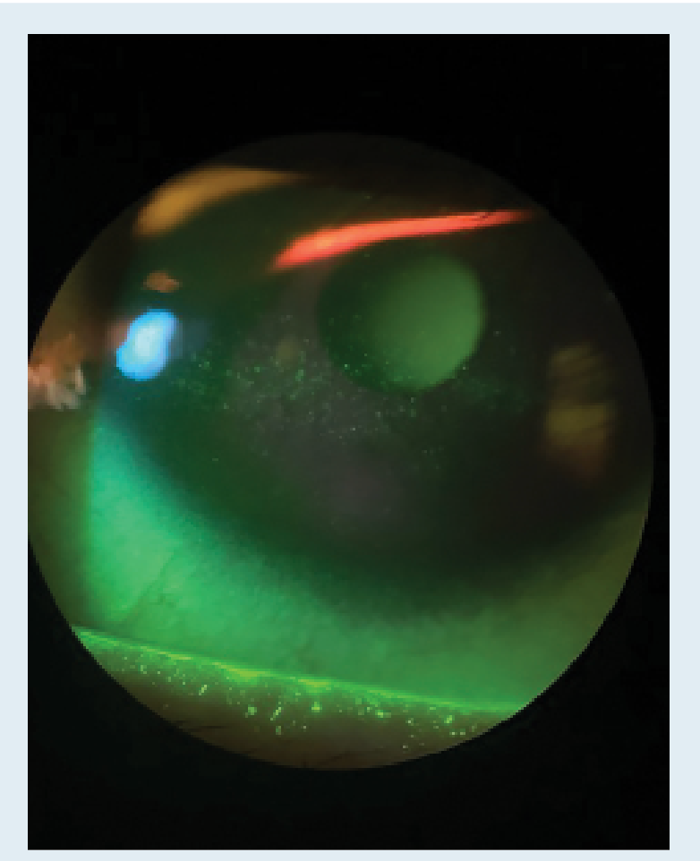 Figure.Superficial punctate keratitis due to dry eye disease (Image courtesy of Cecelia Koetting, OD, FAAO, Dipl ABO)