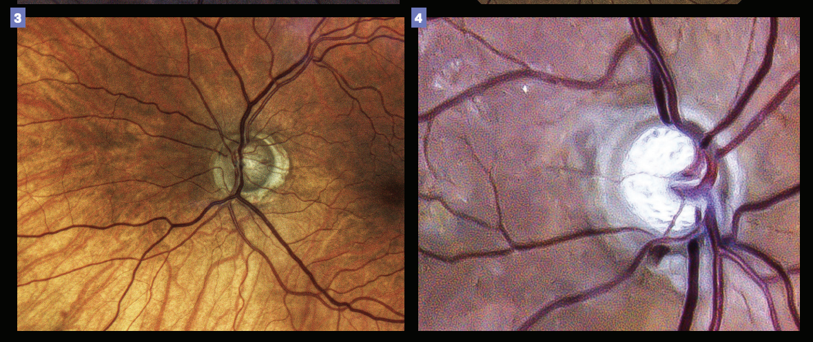 New treatments and surgeries are transforming the glaucoma