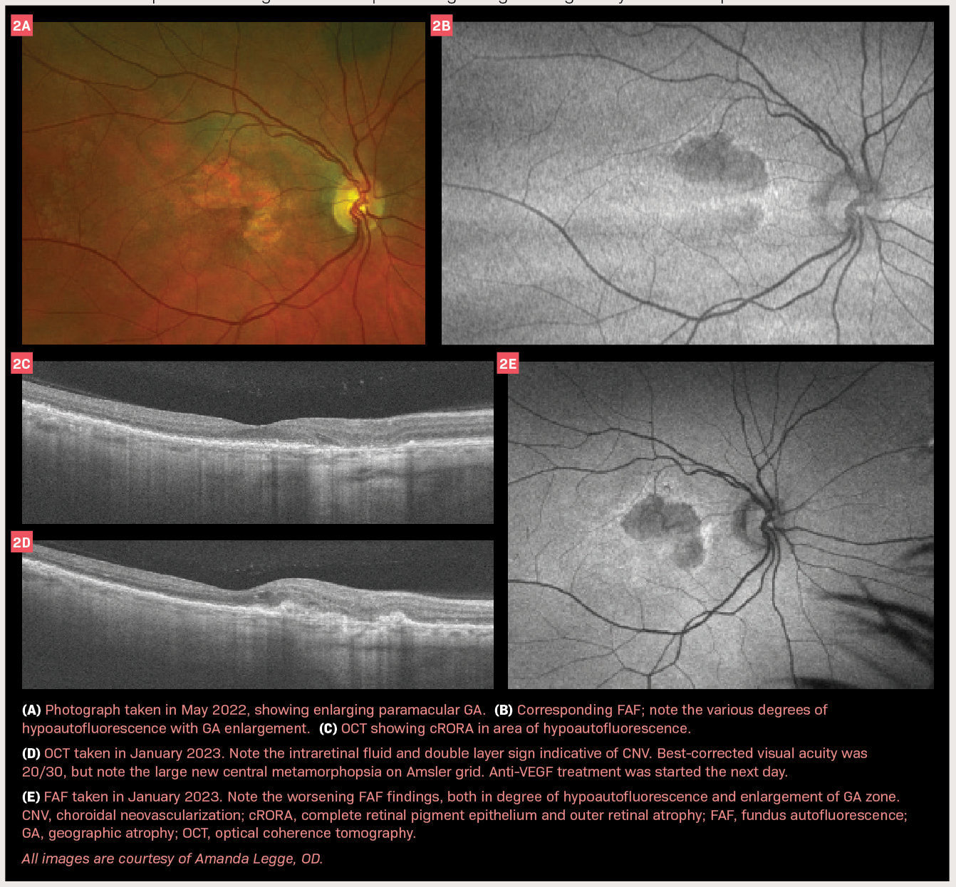 ONL Therapeutics推进Xelafaslatide治疗地图样萎缩的2期临床试验