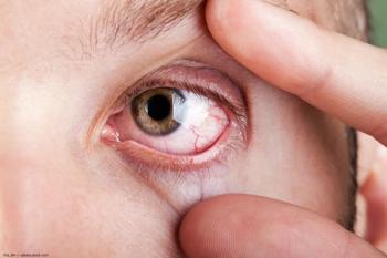 Inflamed eye Image credit: ©ia_64 - adobe.stock.com