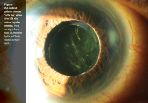 Comanaging intraocular lens  power calculations
