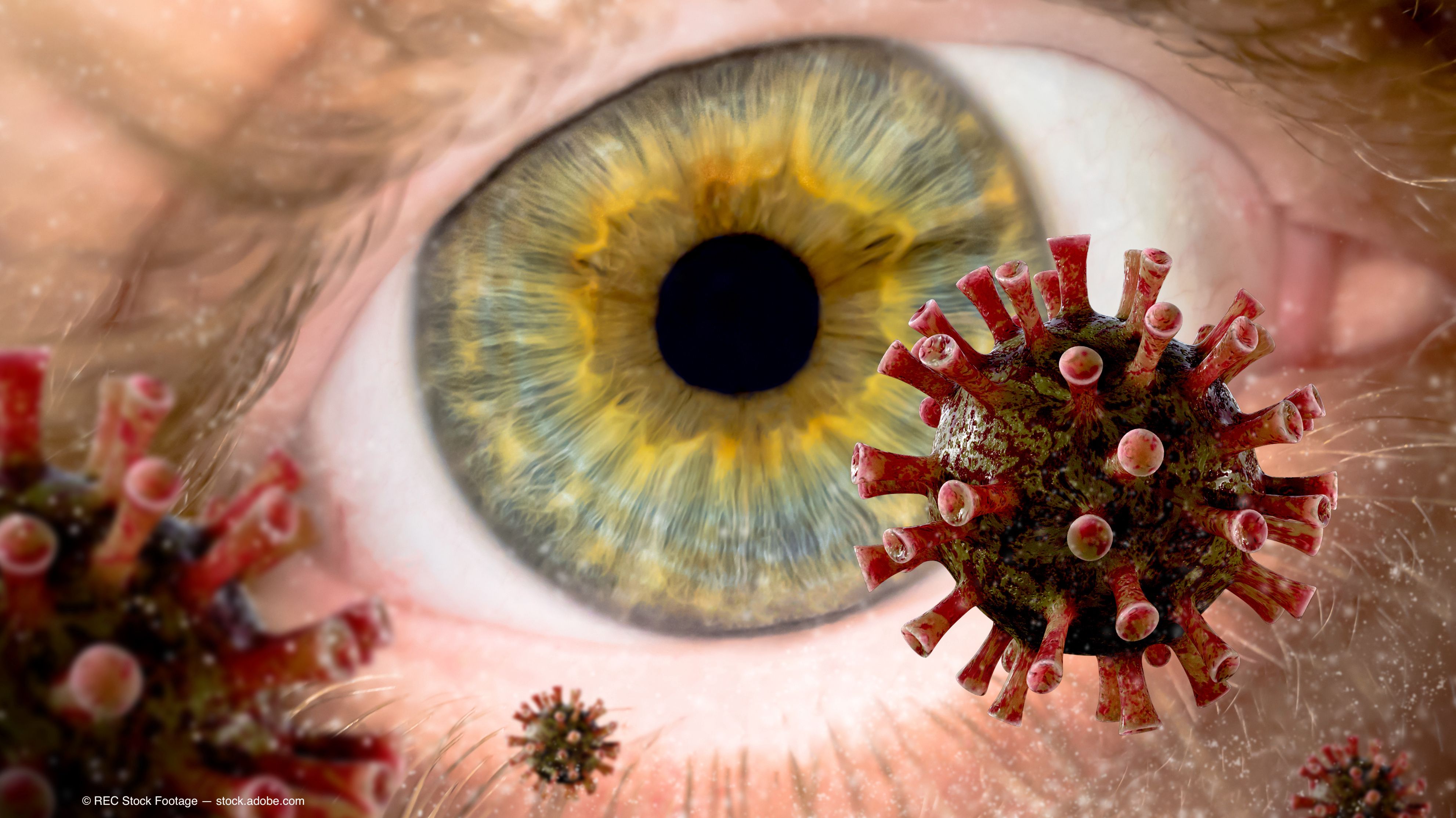  Investigators analyzing the impact of the COVID-19 pandemic on outcomes of infectious keratitis reported that irreversible blindness was prevalent in a substantial number of patients.