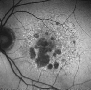 A deeper look at pegcetacoplan