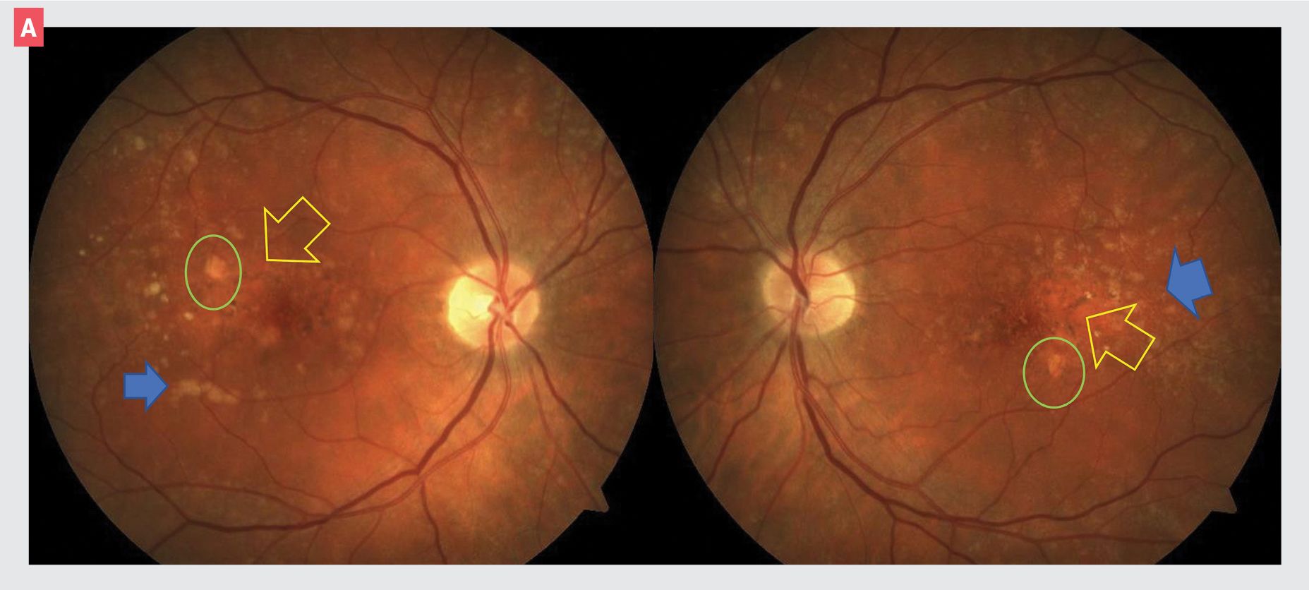 Geographic atrophy: What to know and why