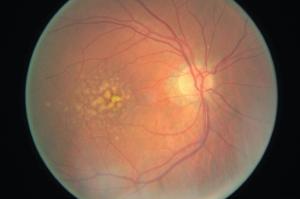 Keeping an eye on geographic atrophy