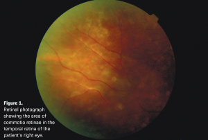 Retinal findings present in pediatric case