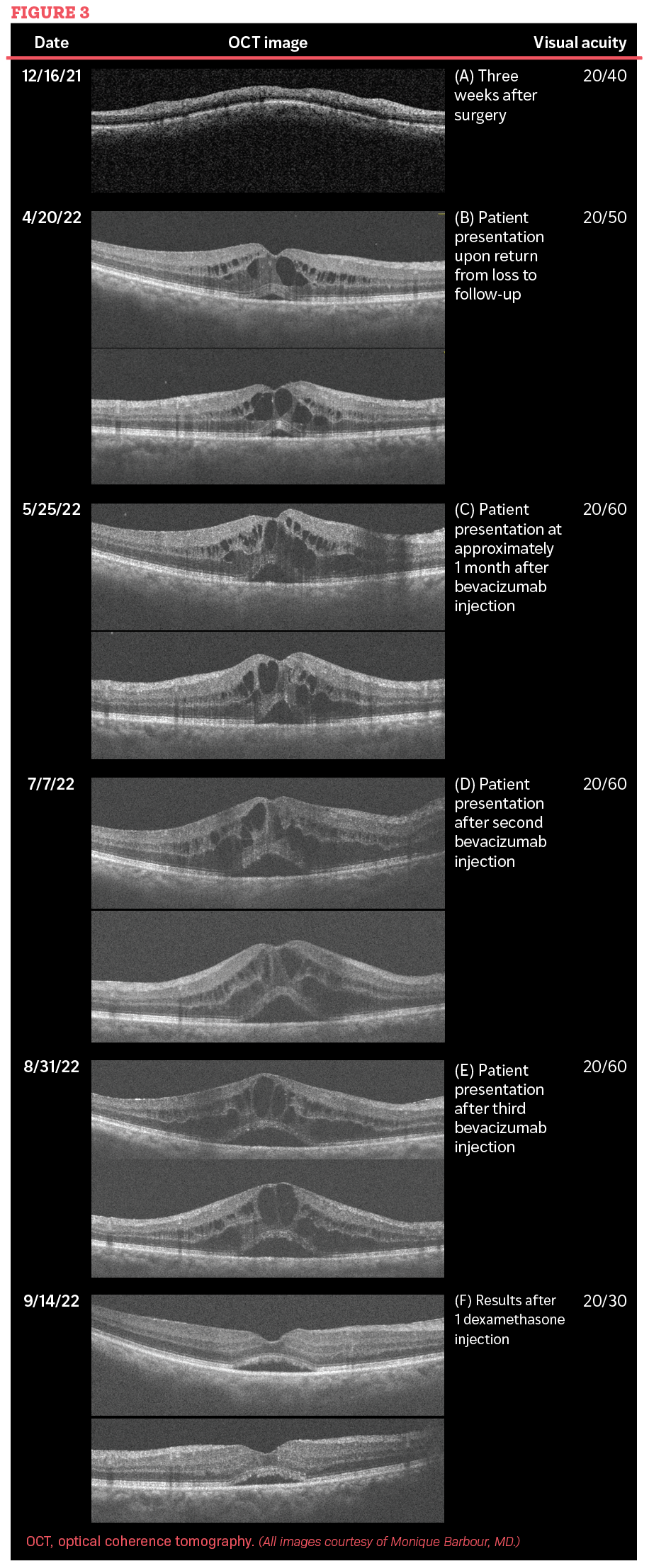 semaglutide and plaquenil Case report: Refractory pseudophakic cystoid macular edema during an exacerbation of scleroderma | Optometry Times