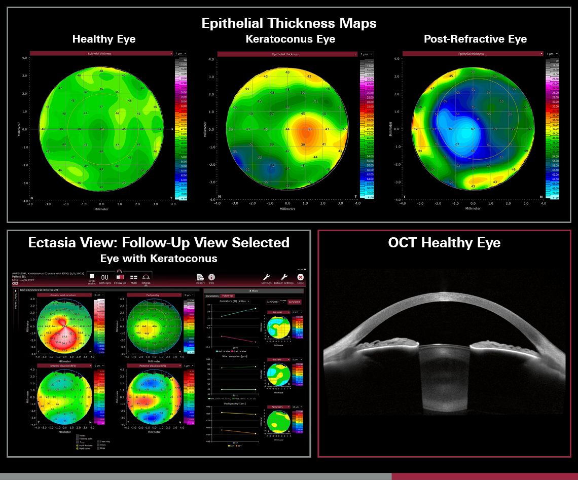 Epithelial Thickness Module imaging Image credit: Heidelberg Engineering
