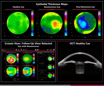 Epithelial Thickness Module imaging Image credit: Heidelberg Engineering