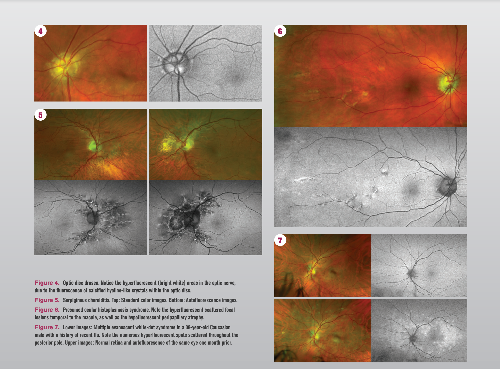 Imaging Helps To Identify Retinal Disease Optometry Times 9240