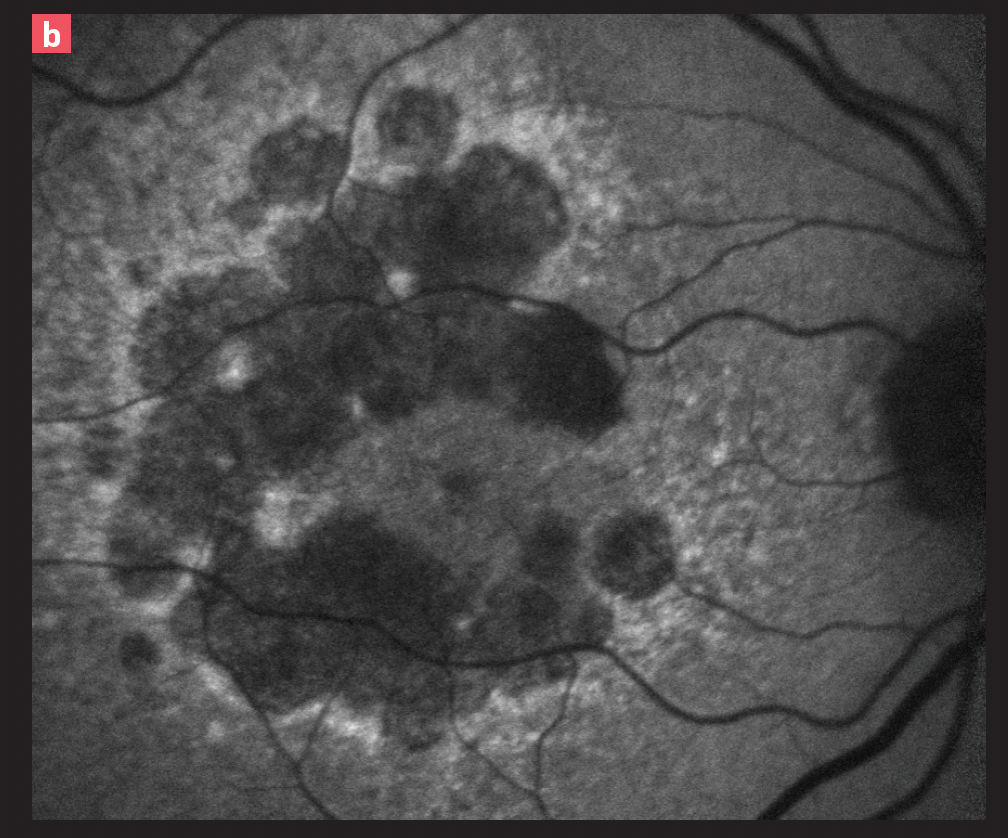 Figure 3. Fundus autofluorescence (FAF) biomarkers can be utilized to predict progression of geography atrophy (GA). In the FAF image of a patient with advanced dry age-related macular degeneration (AMD) shown here, the areas with absence of natural fluorescence of the retinal pigment epithelium (hypoautofluorescence) is associated with GA (red arrow). The bordering light glow, or hyperautofluorescence (yellow arrow), is an indicator of the zone of GA progression.