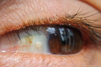 A close up of an eye with Demodex blepharitis - Image credit: Adobe Stock / ©OHishi_Foto