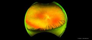 Predicting glaucoma progression: More than meets the eye