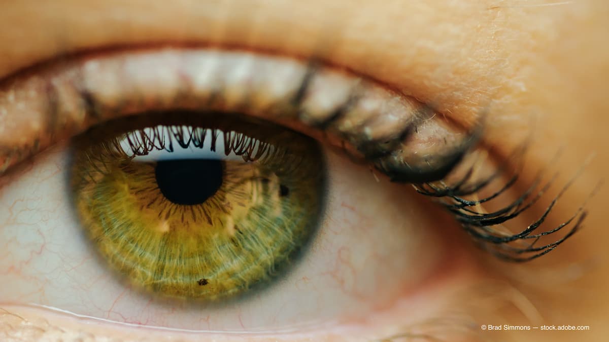 Herpesvirus DNA identified in corneal grafts | Optometry Times ...