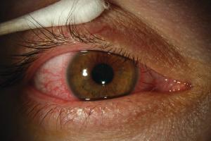 Preparation is key to fighting  dry eye while traveling