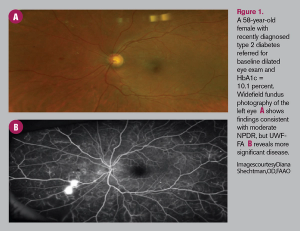 Aflibercept PANORAMA study results in