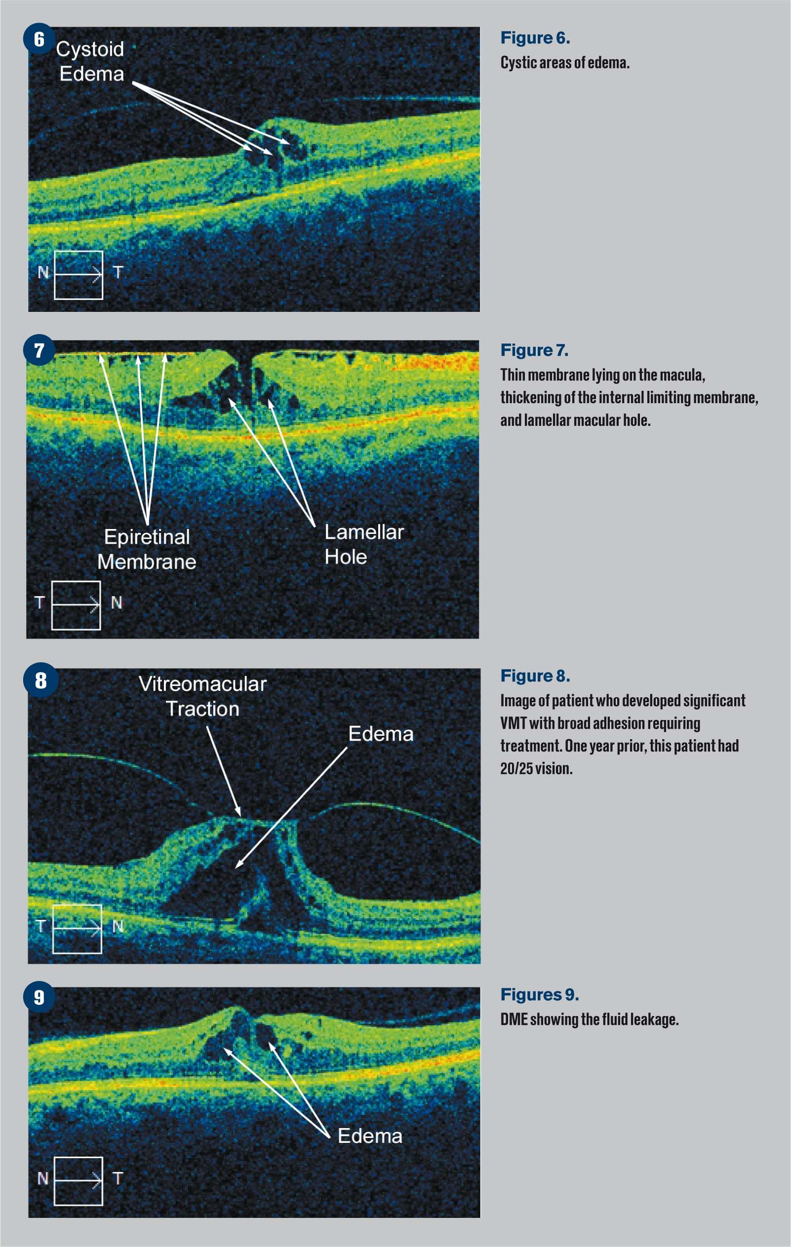 Identifying common macular conditions with OCT