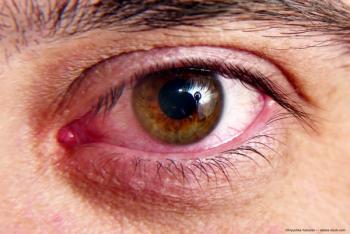 Red and irritated eye Image credit: ©Kryuchka Yaroslav