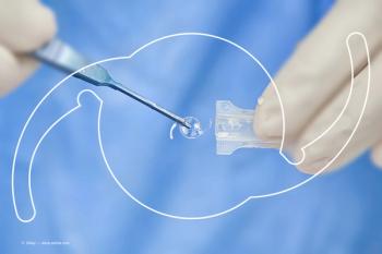 Colombian researchers who assessed the visual results and patient satisfaction, following implantation of the AcrySof PanOptix trifocal intraocular lens (IOL) (Alcon) reported “very good results” in their series of patients, with 96.9% of patients achieving spectacle independence.