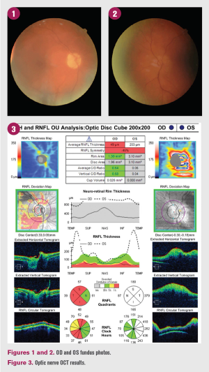 Patient experiences sudden decrease in vision