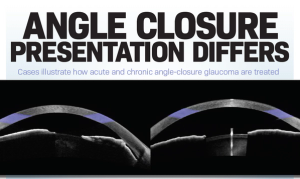Angle closure presentation differs
