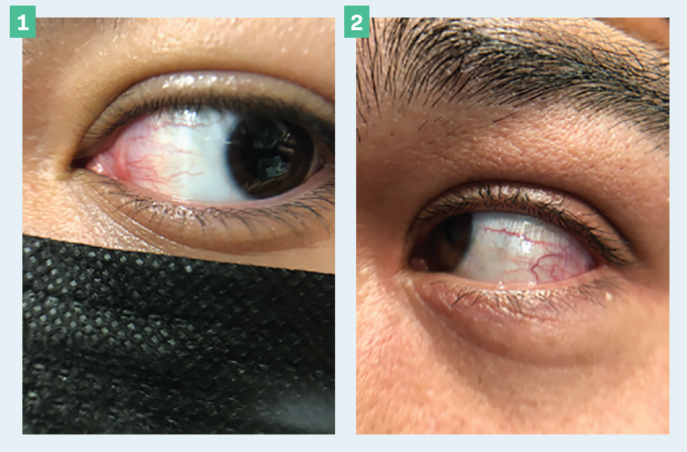 Figures 1 and 2. Redness seen with contact lens discomfort. (Photos courtesy of Milton M. Hom, OD, FAAO)