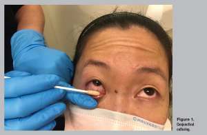 5 questions answered about antibiotic resistance in eye care