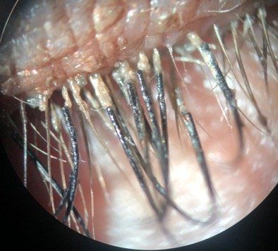 demodex mites infestation optometrytimes