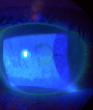 Dry Eye Patient (A)