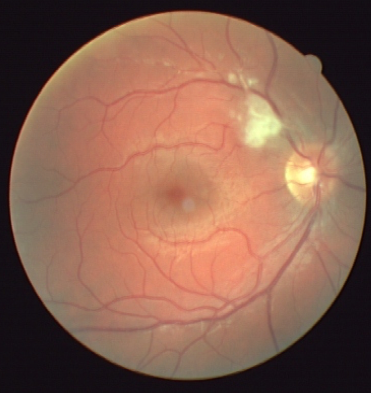 Glaukóma toxoplazma