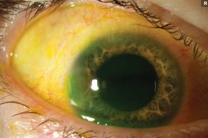 Navigate postop IOP control with wound burping 