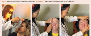 How to implement IPL into an optometry practice