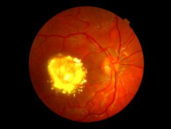 Right and left posterior pole of a 4-year-old patient with suspected Coats disea