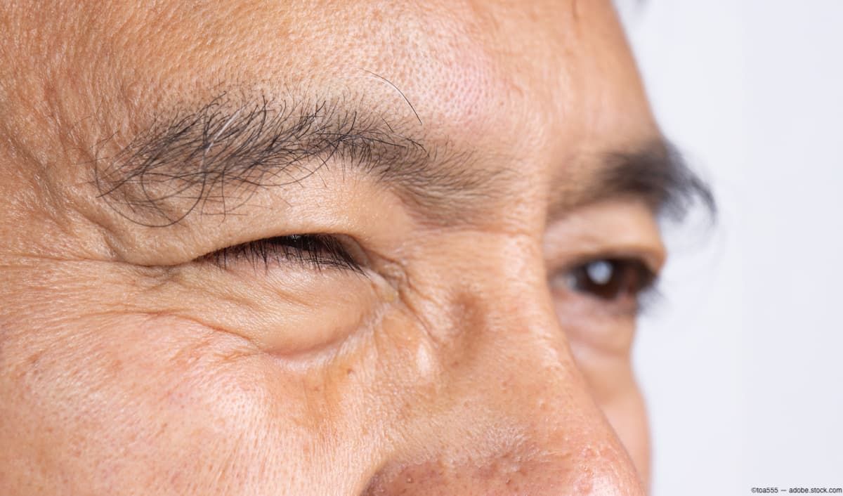 Man squinting Image credit: AdobeStock/toa555