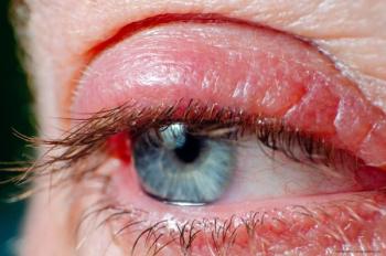 Inflamed red eyelid due to Demodex blepharitis