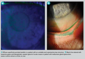 Overlooked causes of dry eye 