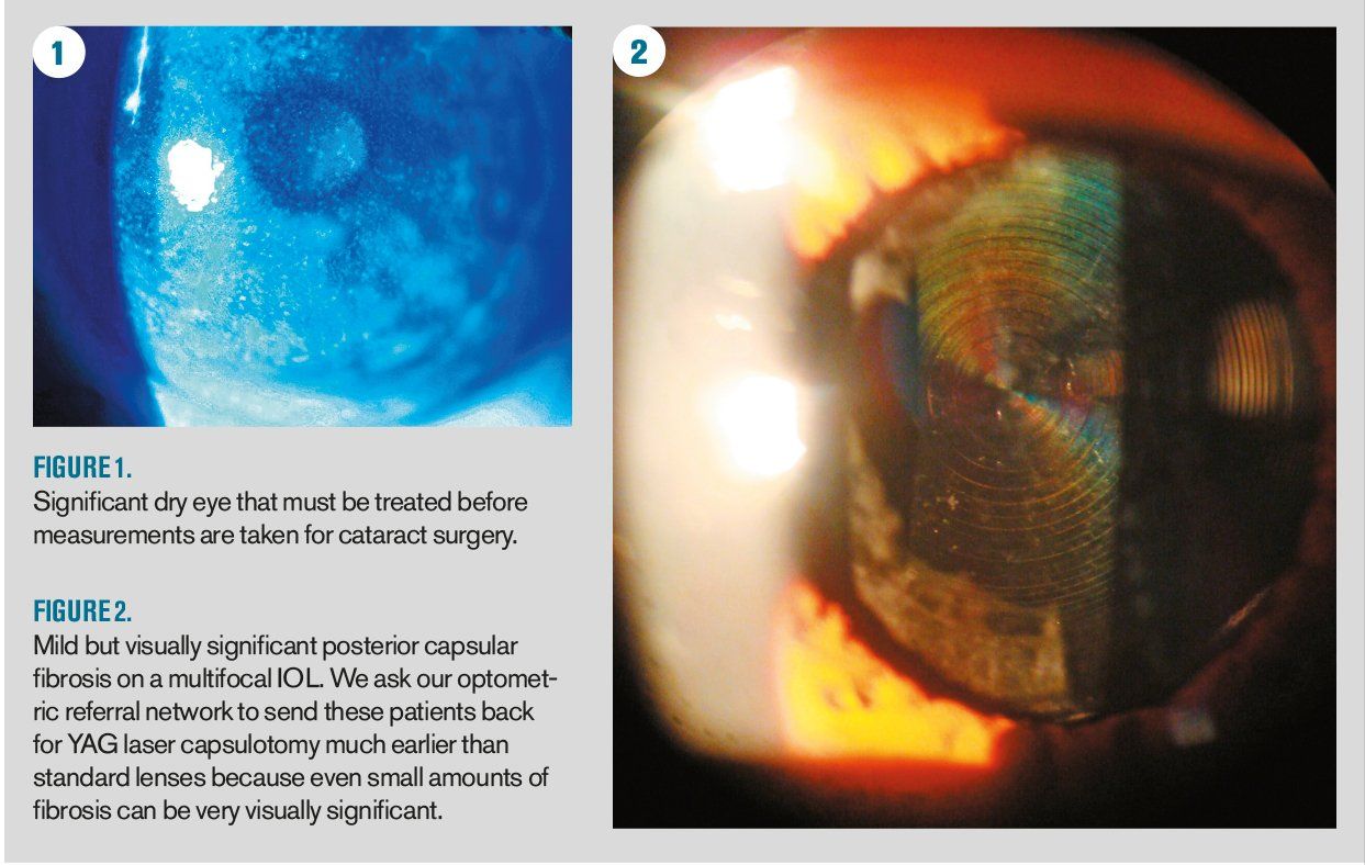 Cataract Surgery Comanagement From The Other Side