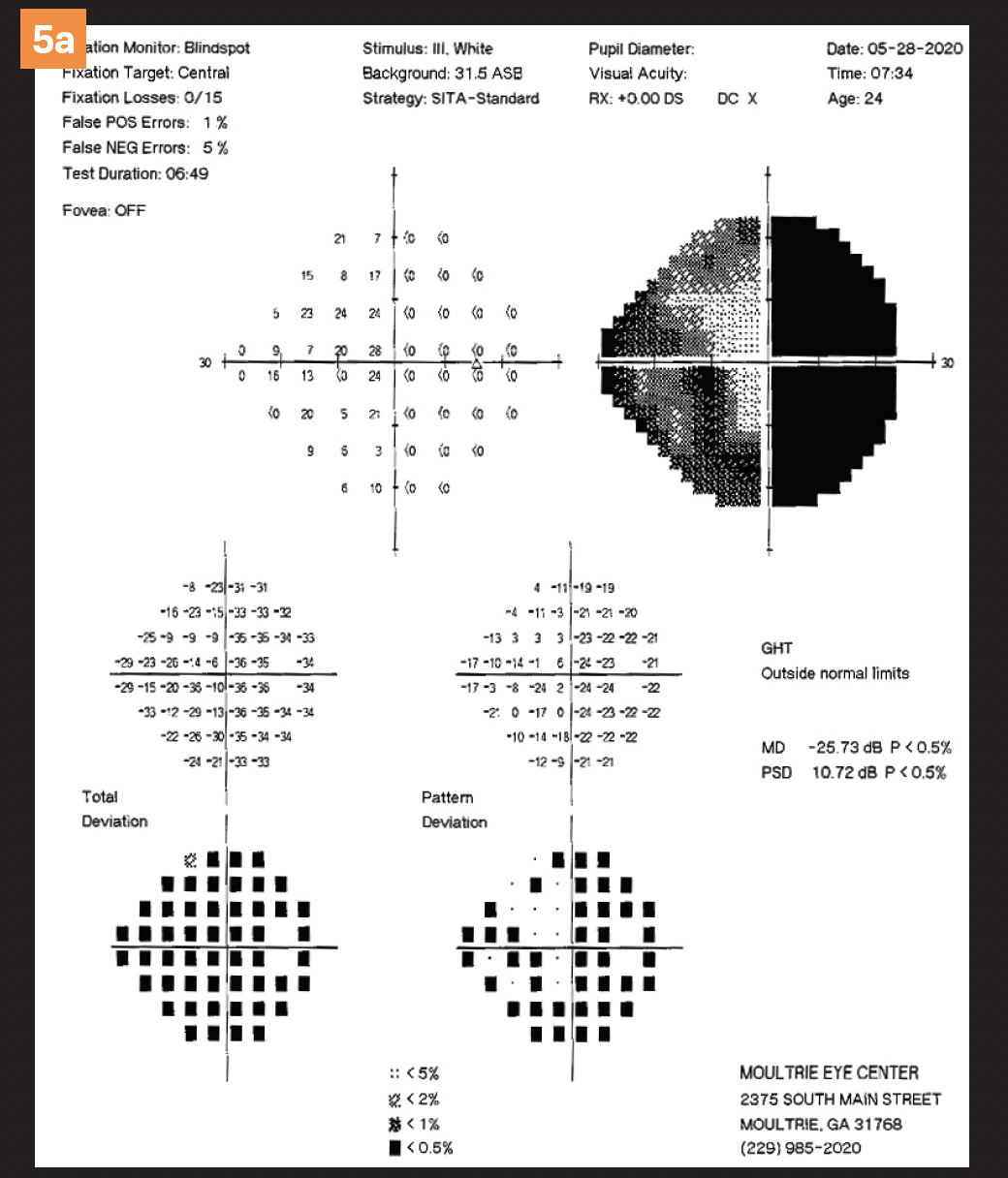 Figure 5 a. Bitemporal visual field defect.