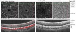 OCT-A evaluation uncovers significant retinal findings in leukemia patient