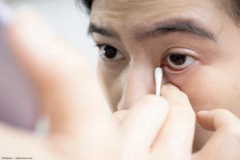 Physician examining ocular glands in patient with qtip Image credit: ©Satjawat - adobe.stock.com