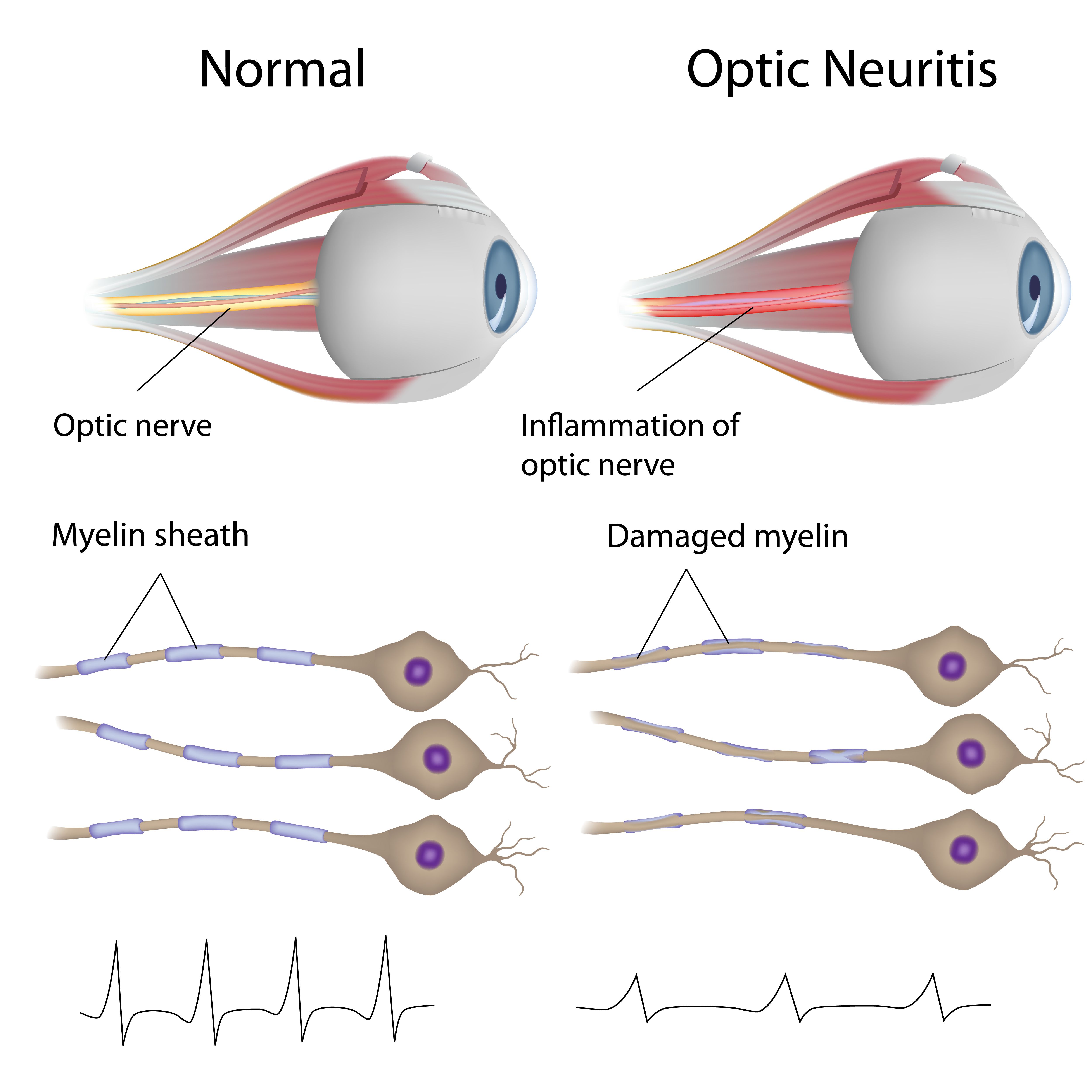 Лечение глазного нерва. Оптический неврит зрительного нерва. Воспаление оптического нерва. Оптический неврит папиллит. Ретробульбарным невритом зрительного нерва.